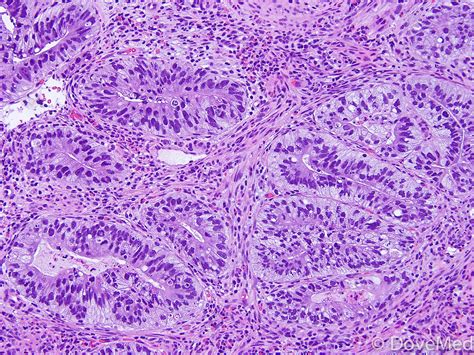 Invasive Adenocarcinoma of Lung