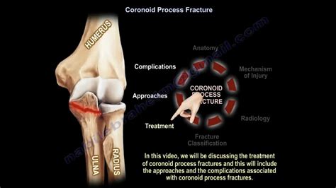 Coronoid Process Of Ulna – It's Anatomy And Function