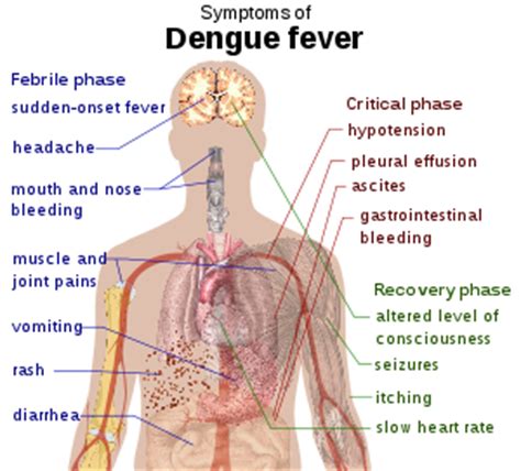 Dengue Hemorrhagic Fever - RNpedia