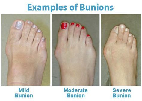Bunion: Causes, Symptoms & Treatment » How To Relief