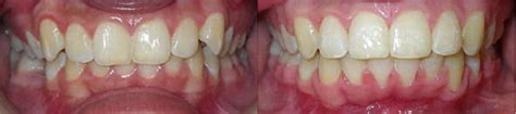 SureSmile Before and After Pictures in Atlanta, GA