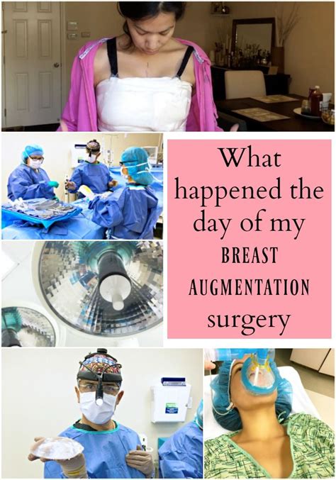 Breast augmentation recovery – Artofit