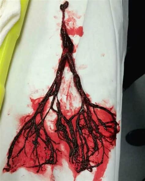 A picture of a blood clot removed from... - Medical Creations