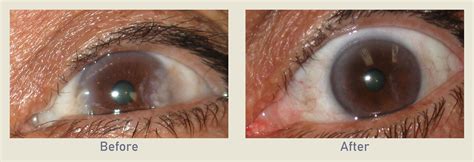 Pterygium Eye Disease