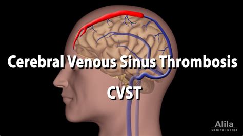 Cerebral Venous Sinus Thrombosis, CVST, Animation - YouTube