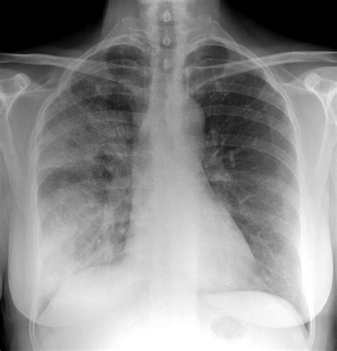 Pneumonia, X-ray Photograph by Du Cane Medical Imaging Ltd - Pixels