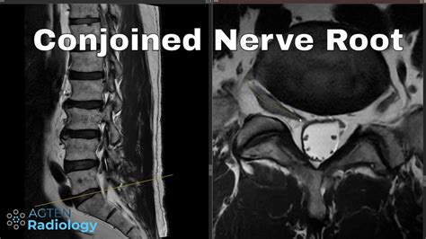 How to detect conjoined lumbosacral nerve roots on MRI - YouTube