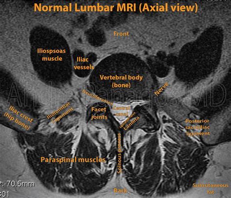 Healthcare Extreme How To Read An MRI Lumbar Spine In 8 Easy Steps