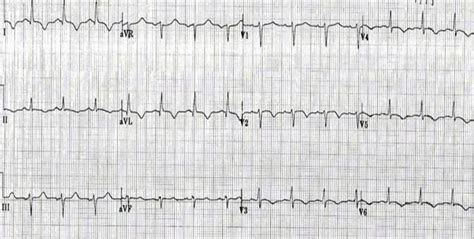 Myocarditis electrocardiogram - wikidoc