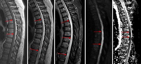 Spinal Cord Infarct | The Neurosurgical Atlas, by Aaron Cohen-Gadol, M.D.