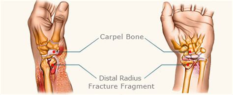 Distal Radial Fractures Treatment | Daniel Calva-Cerqueira