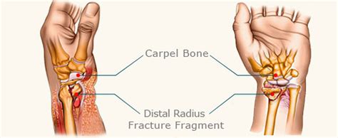 WRIST FRACTURE | Care2Cure Physiotherapy & Rehab Center