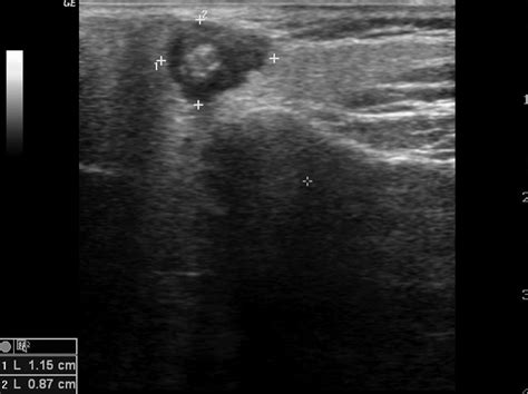 Mucoepidermoid carcinoma echocardiography or ultrasound - wikidoc