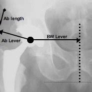 Supine AP X-ray of the right hip joint with a non-displaced subcapital ...