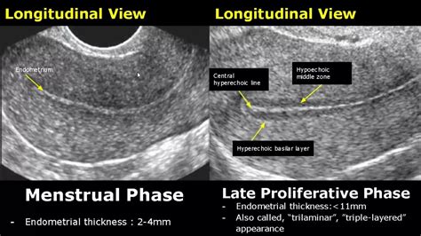 Endometrial Thickness Ultrasound Image Appearances | Endometrium ...