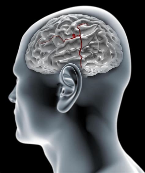 What is a brain aneurysm? Symptoms, signs and causes – all you need to ...