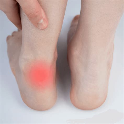 Achilles Tendinopathy: Causes, Symptoms & Treatment | The Feet People ...