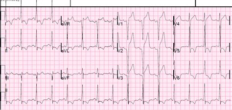 Dr. Smith's ECG Blog: Chest Pain, LVH with Incomplete LBBB, and ST Elevation