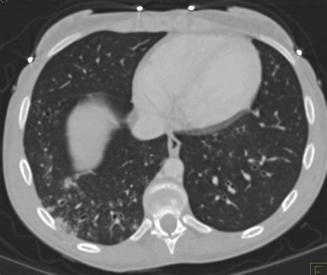 Bronchiectasis and Bronchiolitis - Chest Case Studies - CTisus CT Scanning