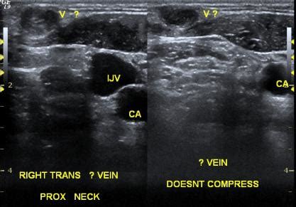 Jugular Vein Thrombosis