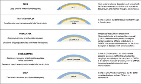 History of Endothelial Keratoplasty | Ento Key