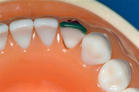 Mandibular Right Lateral Incisor (4.2 FDI, 26 Universal) - Labial and Incisal Veneer Preparation