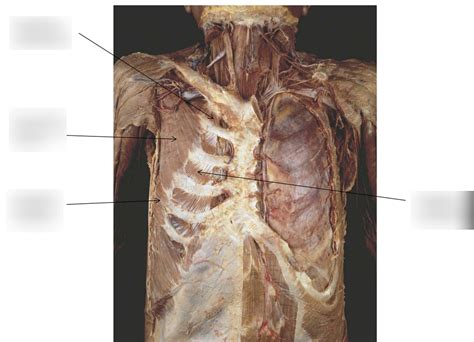 Thoracic Walls Lecture: Muscles of the Thoracic Wall Diagram | Quizlet