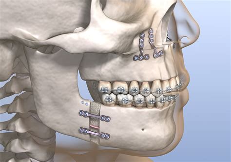 Orthognathic & Corrective Jaw Surgery — North Coast Maxillofacial Surgery | Dr Scott Armstrong ...