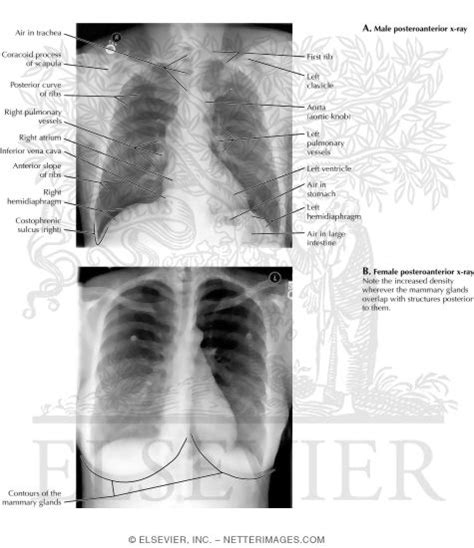 Posterior Anterior (PA) Chest X-Ray (Male and Female)