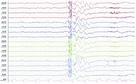 | Electroencephalography of a myoclonic seizure. A burst of generalized ...