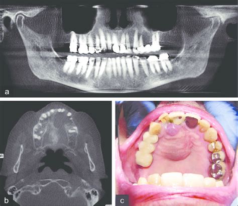 Peripheral Giant Cell Granuloma Radiograph