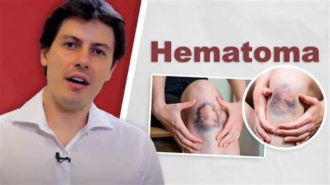 Hematoma: Dr. Fernando Amato - YouTube