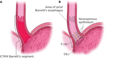 Endoscopy for Barrett’s Esophagus