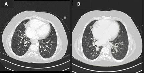 Infectious Complications of DiGeorge Syndrome in the Setting of Malignancy | Cureus