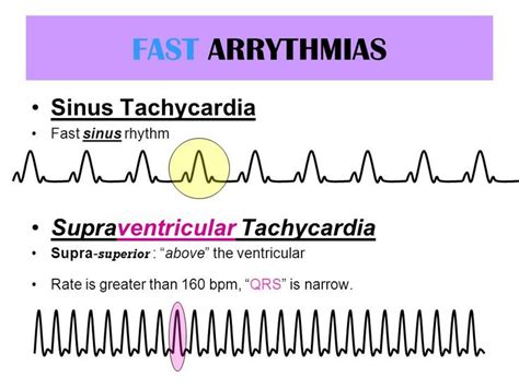 Sinus Tachycardia Vs Svt