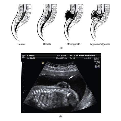 Spina Bifida Ultrasound