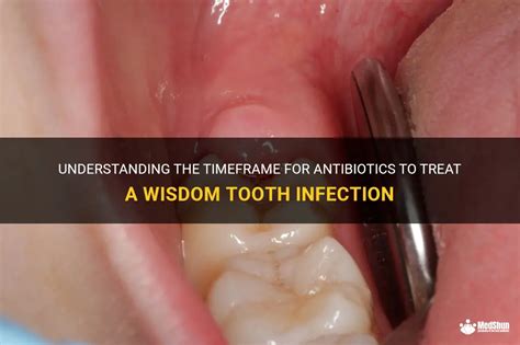 Understanding The Timeframe For Antibiotics To Treat A Wisdom Tooth Infection | MedShun