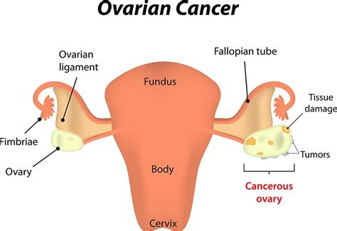 Ovarian Cancer Treatment in Bangalore | Gynecological Cancer