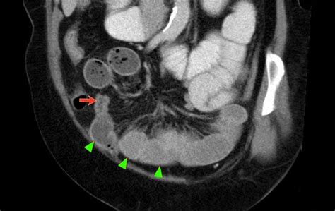 The Radiology Assistant : Closed Loop Obstruction in Small bowel obstruction | Bowel obstruction ...