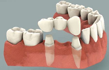 Dental Bridges Oconomowoc - Summit Dental Excellence