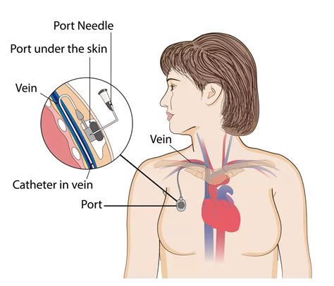 Chemo Port Procedure