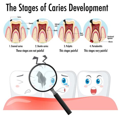 Stages Of Caries Development In A Human Molar Healthy Tooth Dental ...