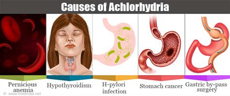 Achlorhydria - Causes, Symptoms, Risk Factors, Diagnosis, Symptoms ...