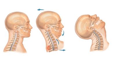 whiplash injury, rta, road traffic accident, slip disc, slipped disc ...