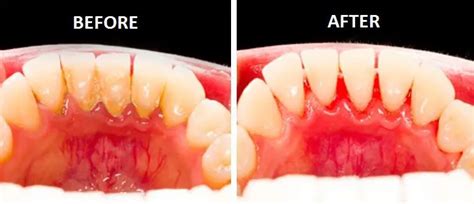 What is Tartar? | Enhance Dental