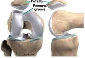 The Dislocated Patella or Kneecap: It Is More Common Than You Think