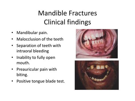 PPT - FRACTURES OF MAXILLA AND MANDIBLE PowerPoint Presentation, free download - ID:2395205