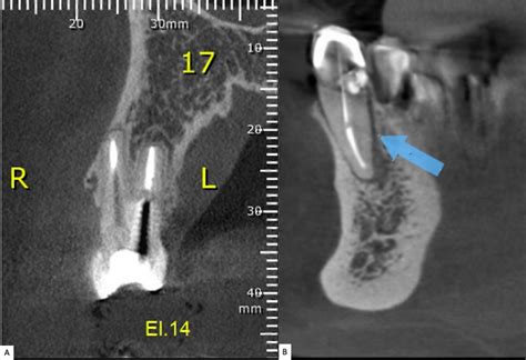 Ceramic implants with immediate and delayed loading in aesthetic regions | Dentistry33