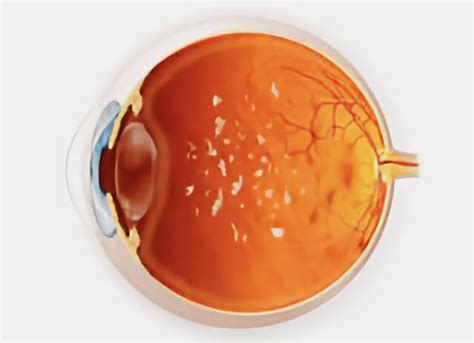 Pars Planitis Treatment | Retinal Consultants Medical Group