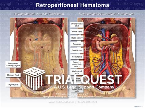 Retroperitoneal Hematoma - TrialExhibits Inc.